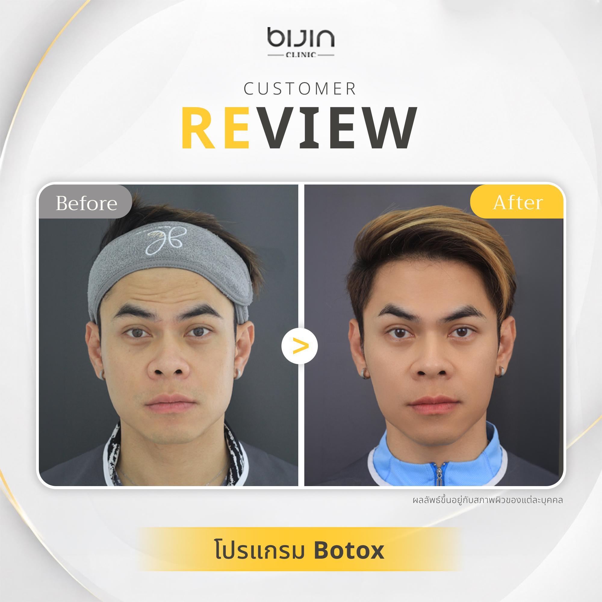 รีวิว Botox และ Filler