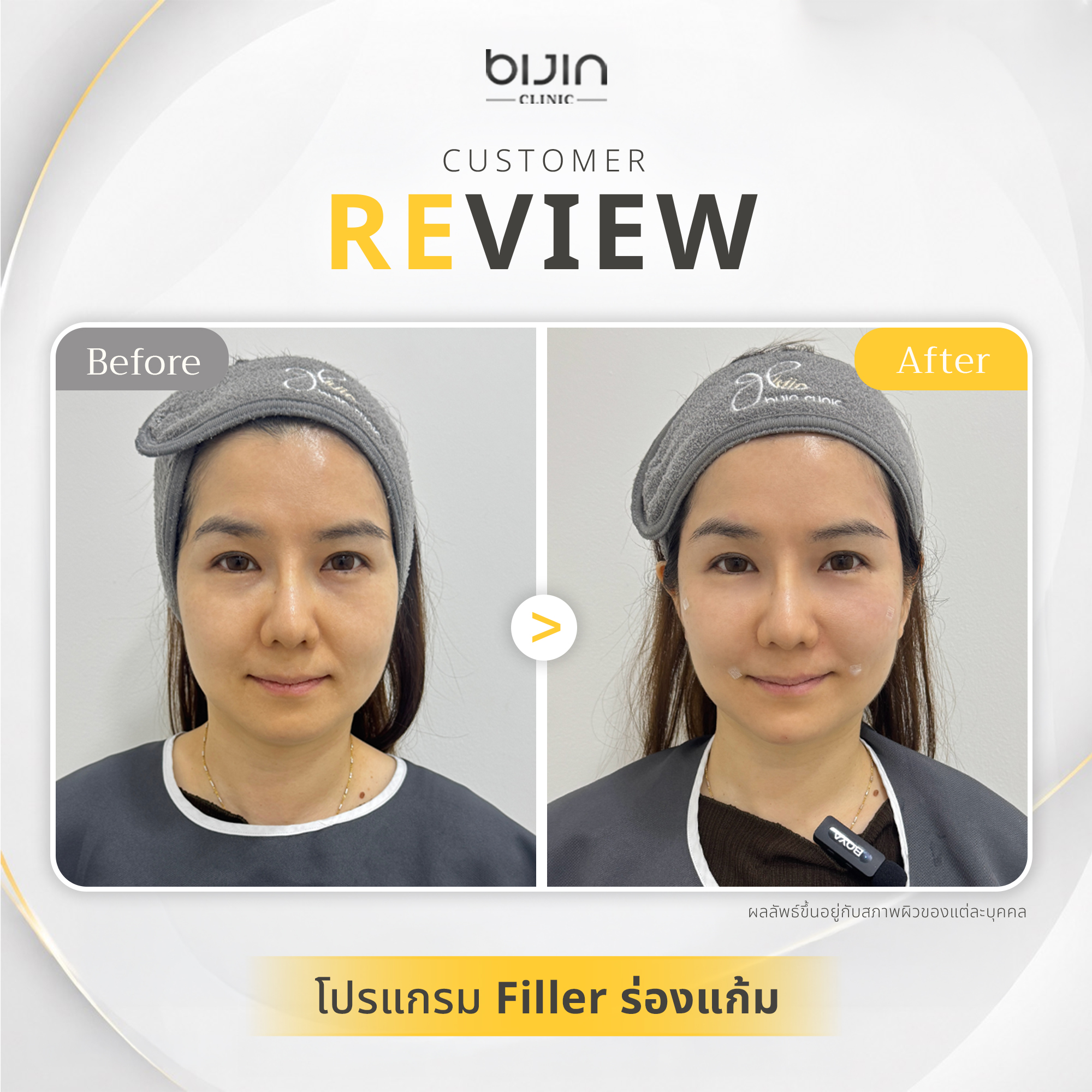 รีวิวงานผิวและฟิลเลอร์