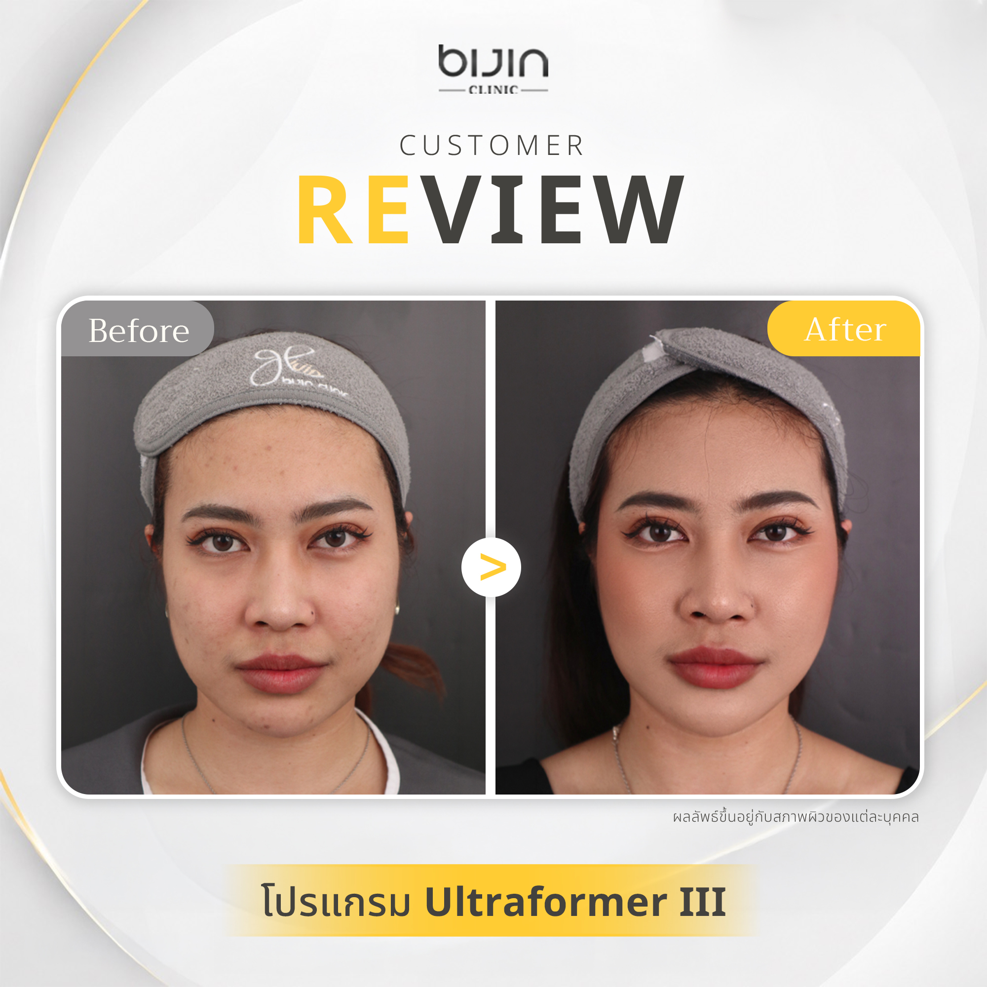 รีวิว Ultraformer III